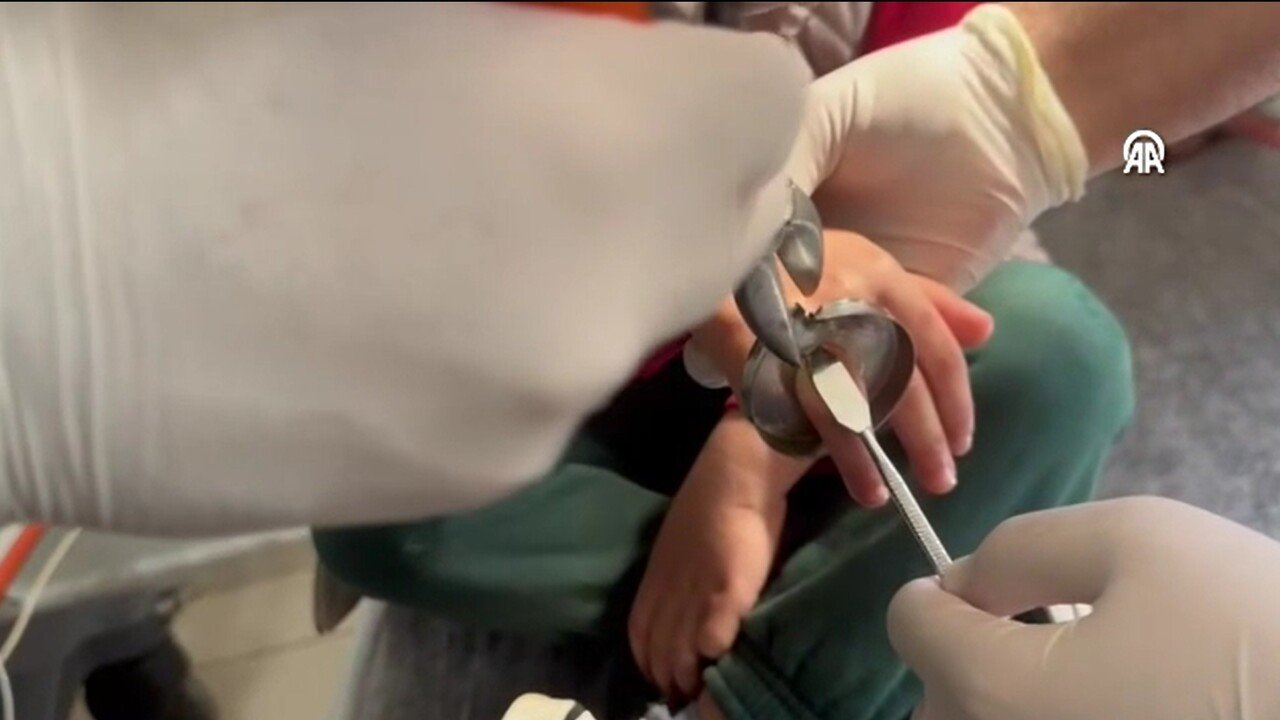 Batmanli Cocugun Parmagina Sikisan Halka Kesilerek Cikarildi