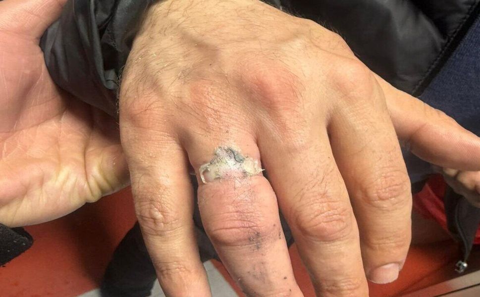 Batman İtfaiyesi Sıkışan Yüzüğü Keserek Çıkardı